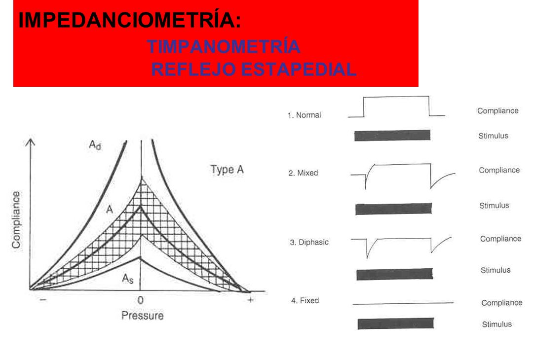 HIPOACUSIAS DE TRANSMISIÓN ppt descargar Impedanciometría: timpanometría y reflejo estapedial